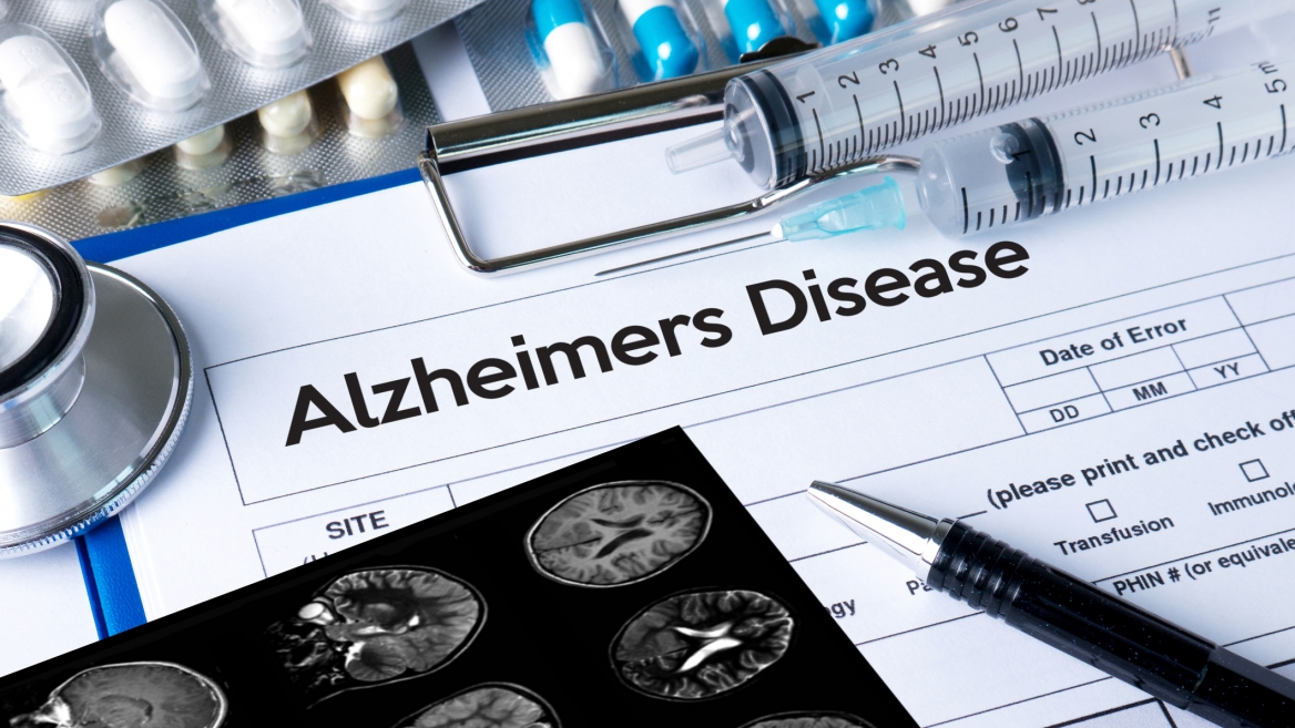 Stock photo of Alzheimer's chart with brain scans and medication